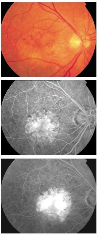 Figure 13 - Classic CNV with loculated fluid. In loculated fluid, dye pooling is well-demarcated in a confined space of a localized sensory retinal detachment or within intraretinal cystic spaces.