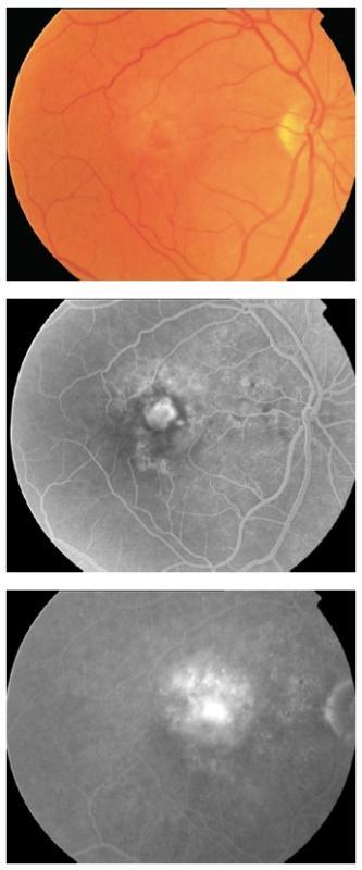 Figure 18 - Minimally classic CNV. The best results with PDT in wet AMD patients were obtained in the treatment of predominantly classic lesions.