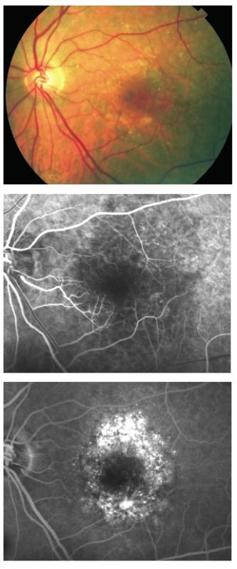 Figure 21 - Late leakage of undetermined source (type II occult CNV). Serous PED Although serous PEDs can occur in the context of non-neovascular AMD, most of them are related to CNV.