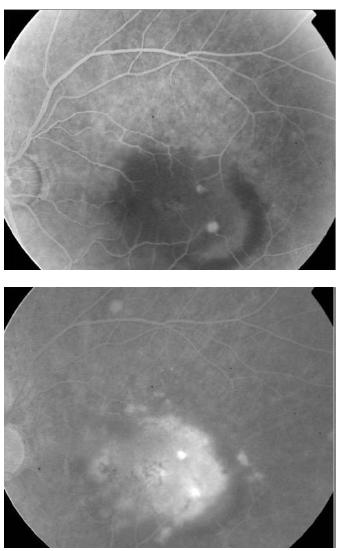 Figure 26 - RAP (stage II). Indocyanine green (ICG) angiography is often more useful than FA for the diagnosis and evaluation of RAP lesions.