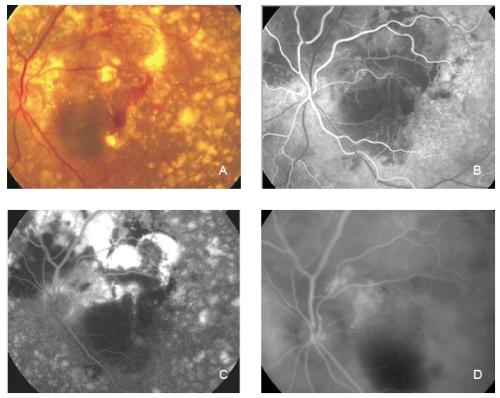 Figure 27 - Polypoidal choroidal vasculopathy. Although FA can sometimes confirm the diagnosis of PCV, ICG angiography is the choice for imaging this entity.