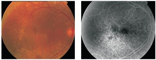 FA is not usually indicated in these cases unless we suspect the presence of choroidal neovascularization (CNV). Several types of drusen can be identified.