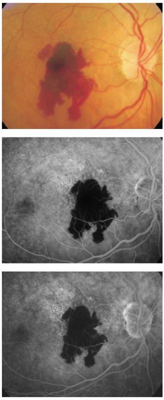 Figure 29 - Hemorrhagic AMD. ICG angiography can detect the presence of occult CNV.
