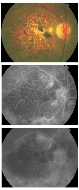 Figure 7 - Severe atrophic AMD with sclerotic appearance of larger choroidal vessels.