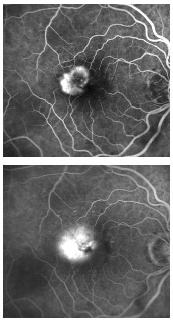 Figure 8 - Classic CNV. As defined by Donald Gass, classic CNV lies between the neurosensory retina and the RPE (type II CNV) (10). Angiographic classic CNV appears as a lacy or bicycle-wheel pattern.