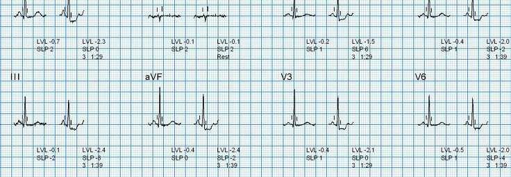 Case. F/65 Stable Angina Presented with exertional chest pain CCS class II for 6 months Hypertension