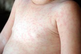 HHV-6, HHV-7 Agents of exanthem subitum, mild childhood rash (sixth disease) >85% of adults have antibody to both viruses Horizontal infection through respiratory secretions,