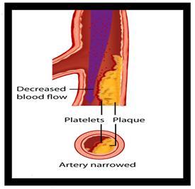 Peripheral Artery Disease (PAD) PAD comes from plaque that narrows or blocks blood flow in the largest artery in the body (aorta) and in arteries to your arms, pelvis, and legs.