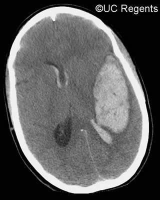 Radiology 45 year old pt with acute intracranial hemorrhage, cerebral