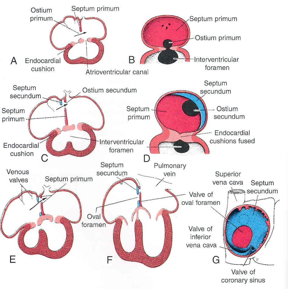 A.P. View of Embryonic septum (A, C, E, F) View of embryonic septum From inside of the Rt.