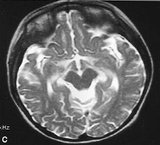 MRI of the brain (A~D).