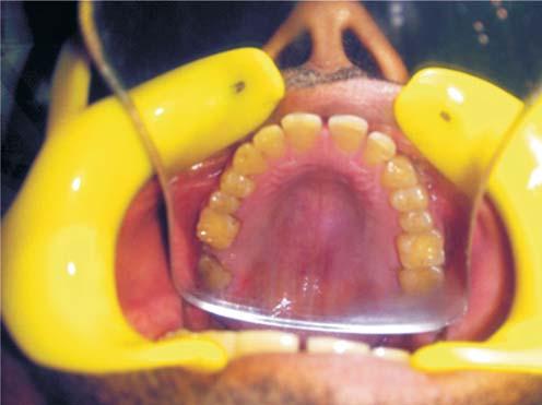 Figure 4: Occlusal wear Figure 5: Posterior teeth contacts in protrusive movement TREATMENT PLAN The foremost goal of the treatment plan was to achieve the joint stability by establishing bilateral