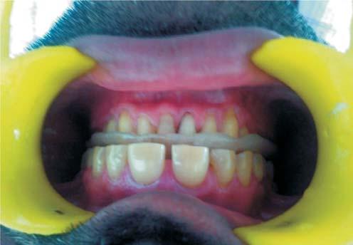 Figure 8: Occlusal splint functional cusps. Posterior disclusion on protrusion and shallow canine guidance for lateral excursions, was established on the splint (Figure 9).