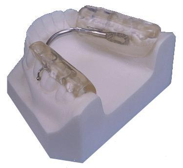 helps prevent clenching, since posterior teeth are not engaged in closing or in parafunctional activities. Recommended as an emergency splint for patients with acute or chronic muscle pain.