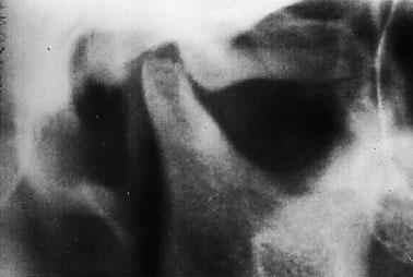 Between July and September 1999, a flattening of the right condylar head and an enhanced (bone) density of the cortex of the right condyle had been noted on routine panorex image and TMJ radiograph.