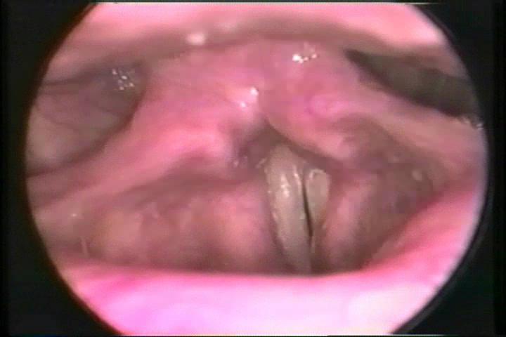 56 year old male Hx sudden onset of hoarseness persistent for three