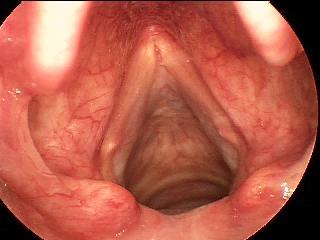 73 year old male Active lecturer Dx: Presbylaryngeus Voice Quality: Mild to mod dysphonia, weak raspy hoarseness