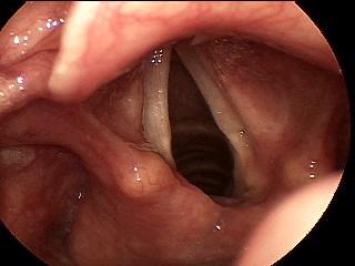 70 year old female Hx: 18 month history of hoarseness and weak voice Dx: Idiopathic LTVF Paralysis Voice Quality: