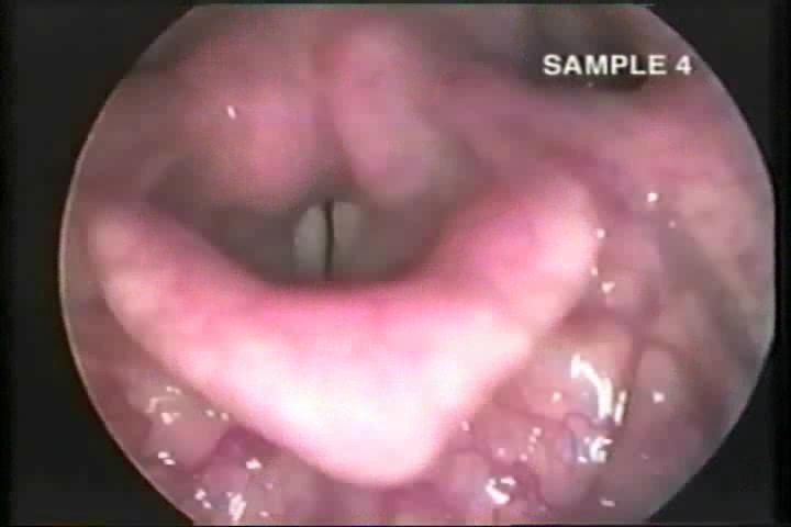 36 year old female Sudden onset of hoarseness following the birth of her child Voice quality: persistent