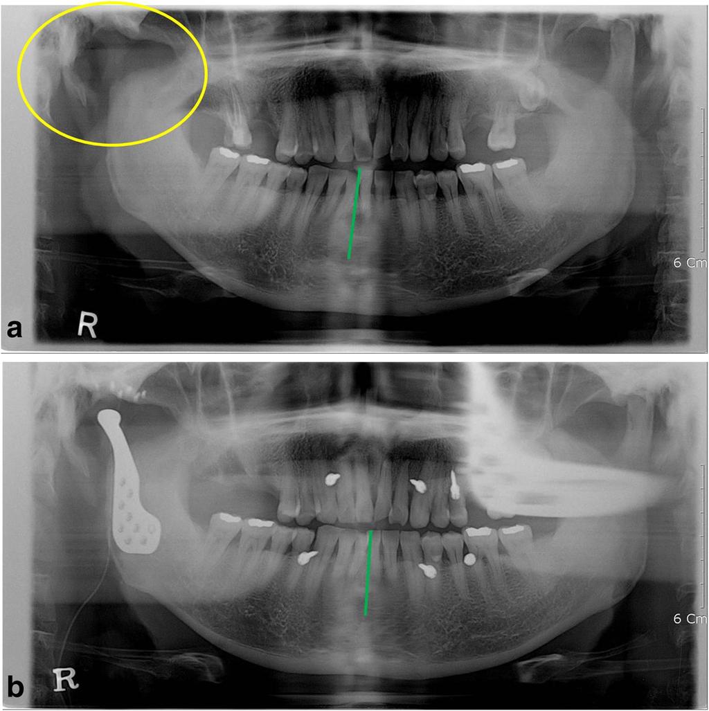 Park et al. Maxillofacial Plastic and Reconstructive Surgery (2017) 39:6 Page 2 of 6 (Fig. 1a). The range of mouth opening was limited to 30 mm of maximum interincisal distance.