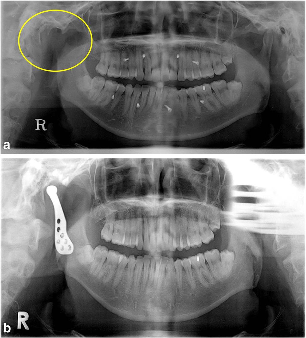 Park et al. Maxillofacial Plastic and Reconstructive Surgery (2017) 39:6 Page 3 of 6 Fig. 2 Case 2. a Right condyle was removed (yellow circle) because of carcinoma of the external auditory canal.