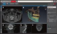 For the first time, a 3D solution is available that allows analysis of the upper airway and treatment of obstructive sleep apnea in a purely digital workflow thanks to the new SICAT Air software.