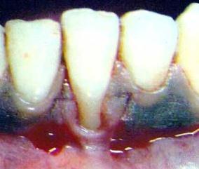 Case Report: A 25 years old male patient visited the department of Periodontics, S. N. Dental College, Gulbarga with a chief complaint of sensitivity of a tooth in lower anterior region.