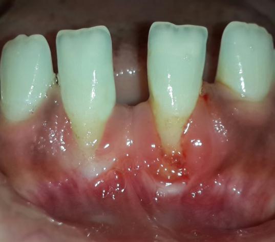 College & Research Center Indore (MP) with the chief complaint of longer lower front tooth that was sensitive to cold. The patient was systemically healthy and exhibited fair oral hygiene.