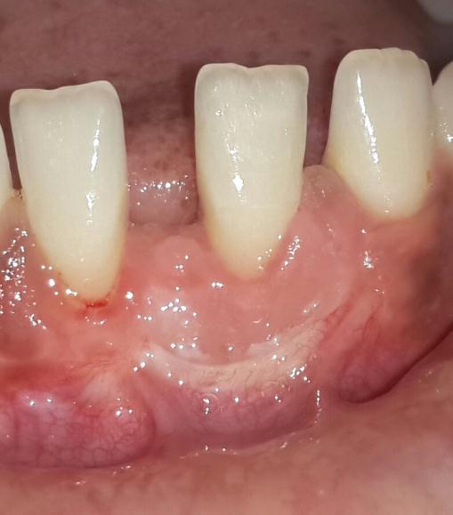 gingiva Clinical attachment level 10mm 9mm 3mm Percentage of root coverage was 13% at two months (Photo-6) PHOTO-6 POST-OPERATIVE VIEW AT 2 MONTHS Percentage of root coverage was 88% at six months