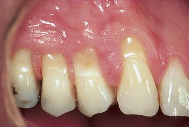Often found at sites with clinically healthy gingiva.