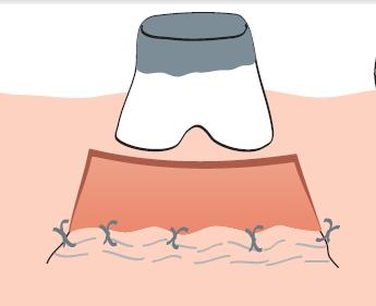 Suture the flap where the apical portion of the free graft will be located. Three to four independent gut sutures are placed.