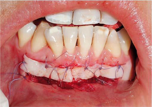 STRIP TECHNIQUE Consists of two or three strips of gingival donor tissue about 3 to 5 mm wide and long enough to cover the