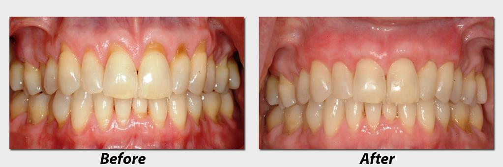 Root Coverage The main indications : 1. Esthetic/cosmetic demands 2. Root sensitivity 3.