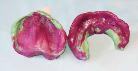 impressions and records. Figure 5 Maxillary occlusal rim is contoured for lip support, smile line and buccal corridor with midline and high lip line markings.