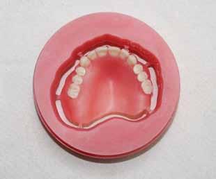 Figure 19 Portrait IPN Denture Teeth are bonded into milled pockets.