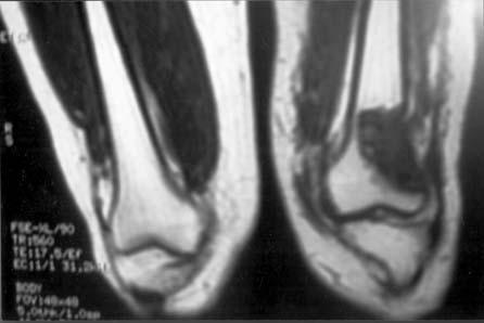 (-A): Pre-operative MRI for a patient with GCT upper tibia. Fig.