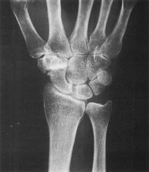 376 PATTERSON Fig 1. Case 1. Close-up of right wrist, showing osteoarthritis of trapezioscaphoid joint. A wrist-working splint relieved the pain. Case 2.