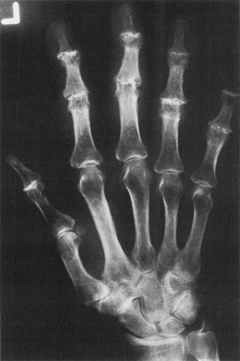 Examination showed tenderness in the anatomical snuff box and over the proximal skin crease of the wrist on the radial side; pain was reproduced by force flexion and extension of the wrist.