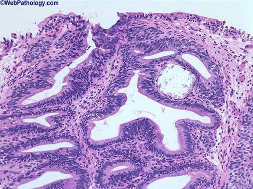 Cystitis glandularis (figure 4), is similar to cystitis cystica except that the transitional cells have undergone glandular metaplasia (Mostofi et al, 1973; Epstein et al, 1998).