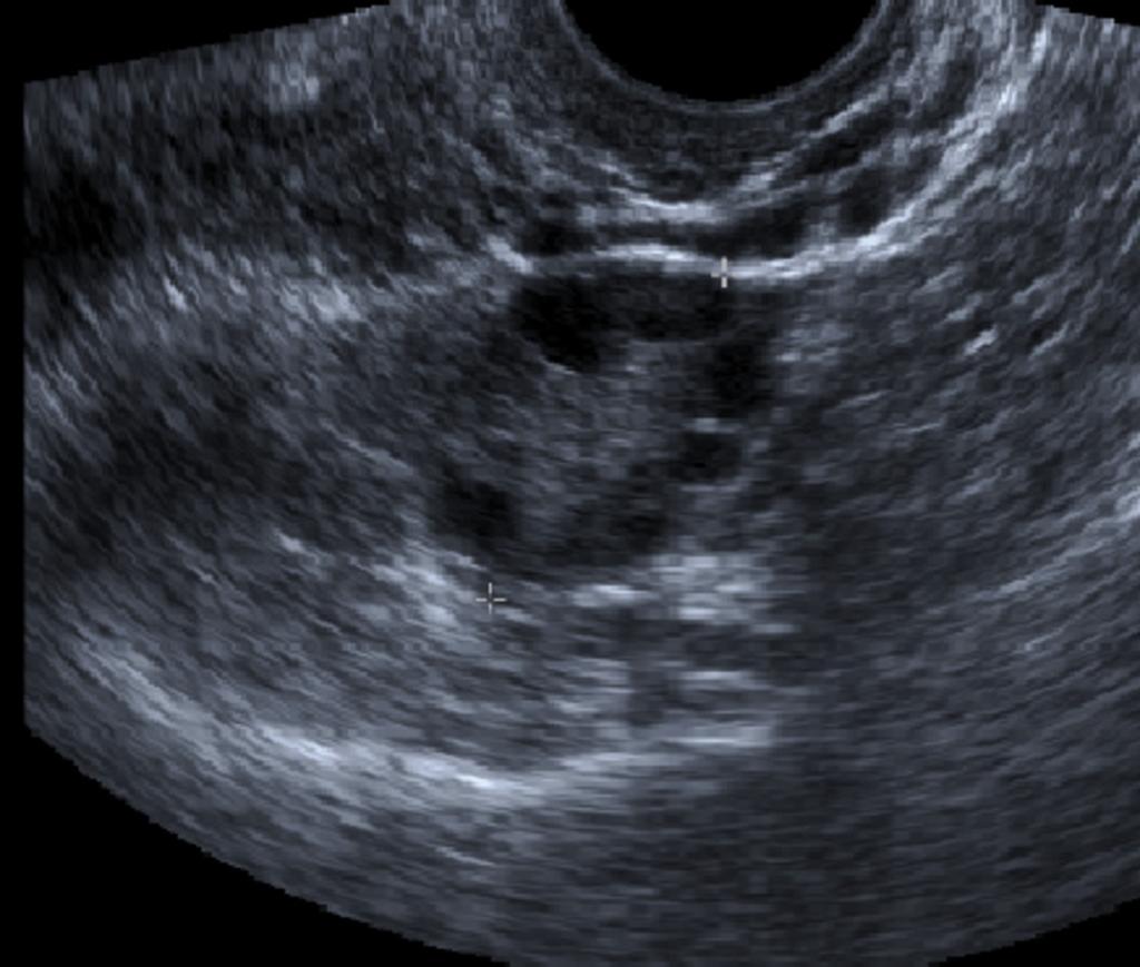 Fig. 4: Image 4: The same woman whose scan showed a dominant follicle and unconvincing evidence of PCO morphology [Images ] was re-scanned on day 5 of her cycle.