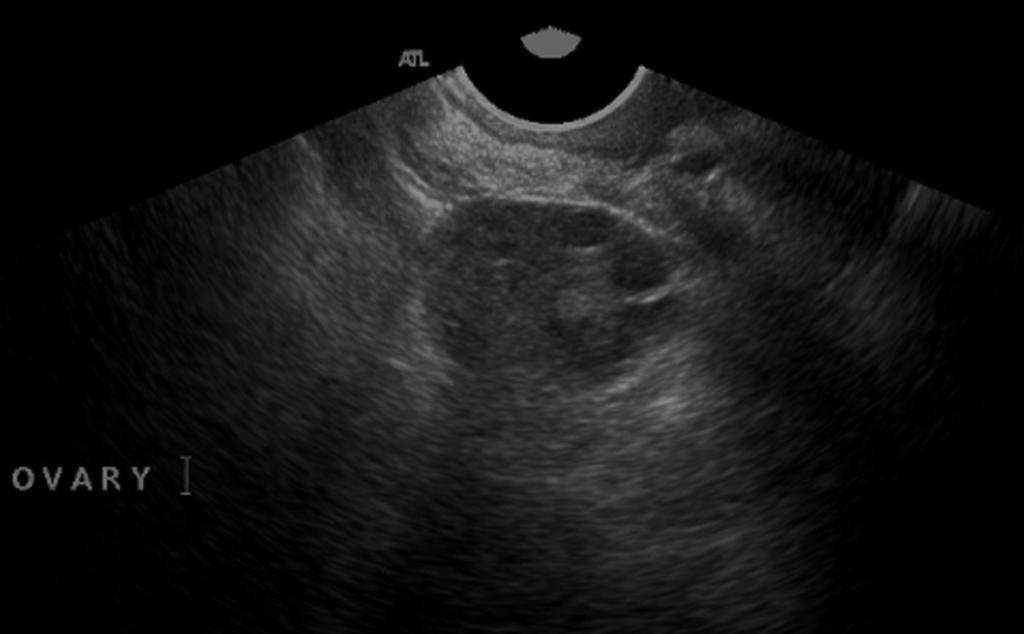 Fig. 6: Image 6: This 38 year old woman had a scan request for pelvic pain which stated "known PCOS".