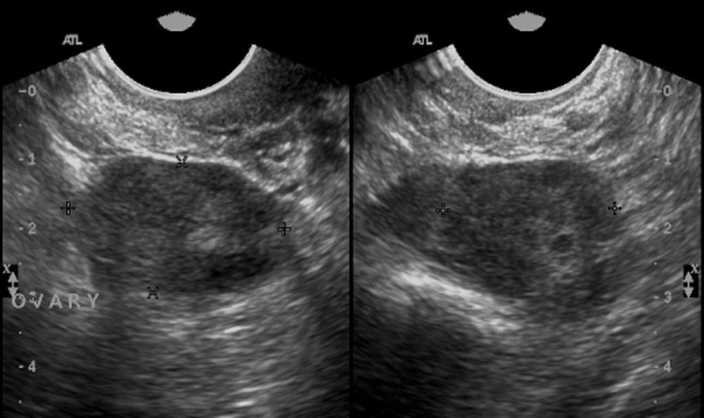 Fig. 7: Image 7: This 38 year old woman had a scan request for pelvic pain which stated "known PCOS".