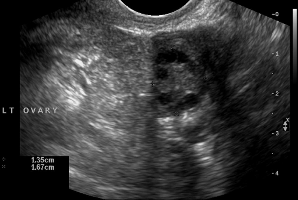 Fig. 9: Image 9: The TV-US scan of this 23 year old woman demonstrates an TS image of an ovary that fulfills the Rotterdam criteria for PCO with regards to follicle number and size.