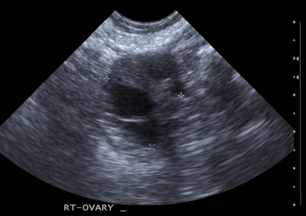 Fig. 2: Image 2: TS image of an ovary with a dominant follicle measuring 12mm in size in a 27 year old woman who underwent TV US