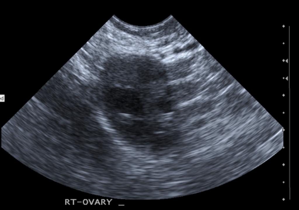 Fig. 3: Image 3: LS image of an ovary with a dominant follicle measuring 12mm in size in a 27 year old woman who underwent TV US