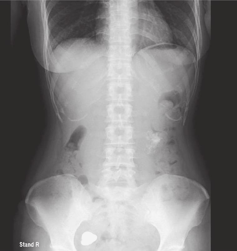 92 Figure 1A Abdominal plain film upright Figure 1B Abdominal plain film supine Figure 1 Abdominal film shows a round radiopaque area with a large rough section of calcification in the upper quadrant.