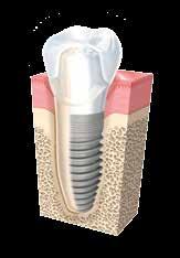 Dental implants can be used to replace one tooth or several teeth. The dental implant is a small post composed of titanium metal that is surgically placed into the bone under your gums.