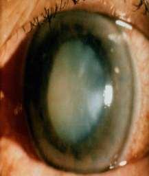 Clinical Presentation sudden pain Blurred vision sudden and more than that due to cataract Halos High IOP usually > 35