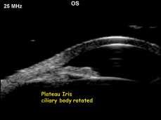 com Aetiology & Predisposing Factors Intumescent cataract Traumatic cataract Rapidly developing senile cataract Smaller