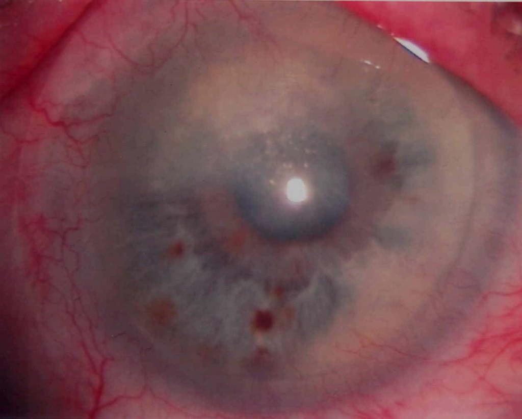 Penetrating Keratoplasty : C l i n i c a l c a s e s - Thread relaxation - After thread removal (only
